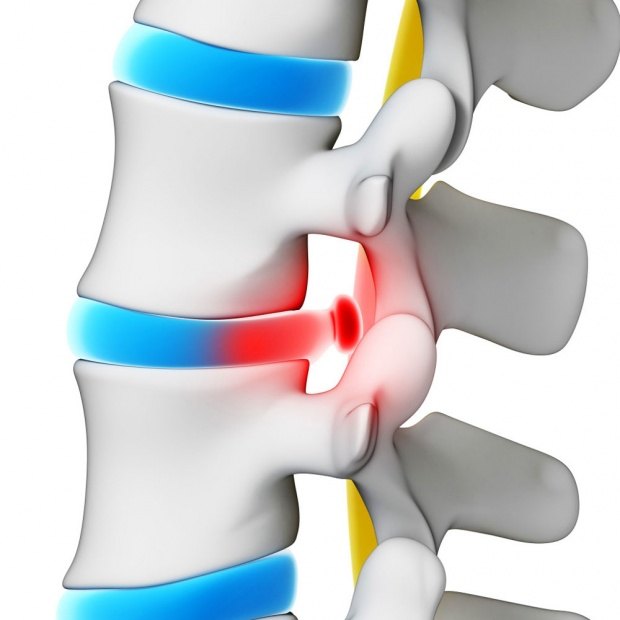 Межпозвонковая грыжа диска